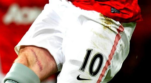Cận cảnh vết rách trên đùi của Rooney đã lành lặn...